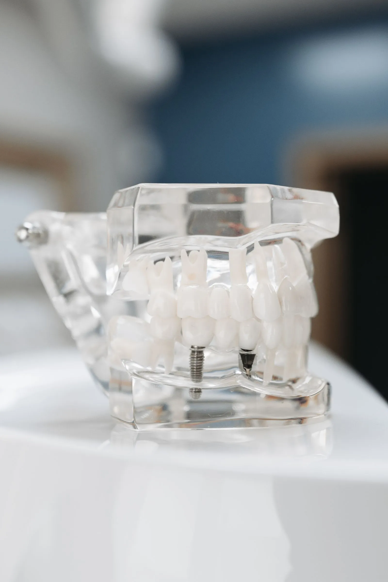 Modelo dental transparente mostrando un implante de titanio junto a piezas naturales