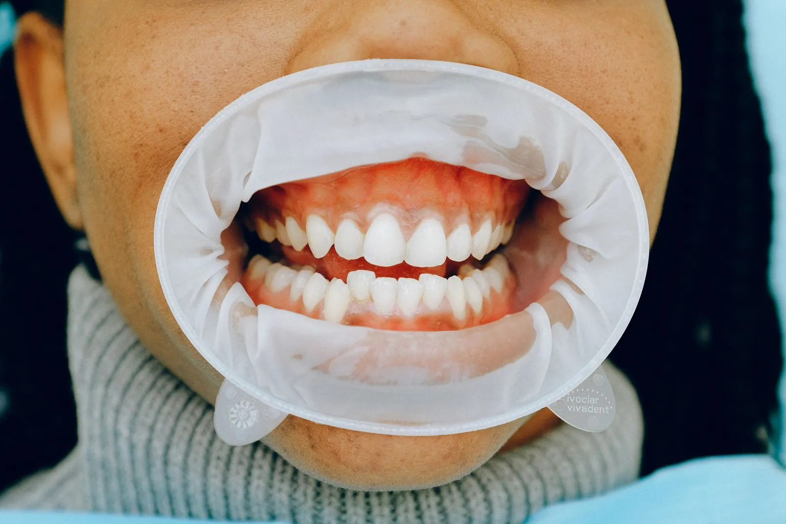 Primer plano de una boca con retractor bucal mostrando dientes y encías